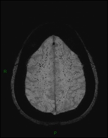 Cerebral fat embolism (Radiopaedia 35022-36525 Axial SWI 47).jpg