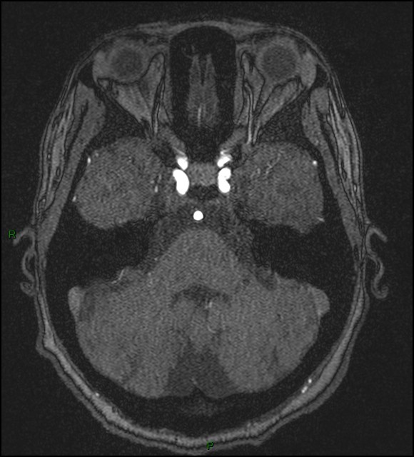 Cerebral fat embolism (Radiopaedia 35022-36525 Axial TOF 51).jpg