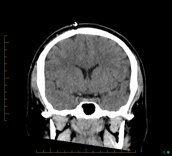 Cerebral fat embolism (Radiopaedia 85521-101224 Coronal non-contrast 27).jpg