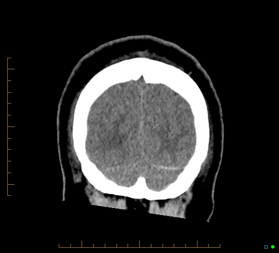 Cerebral fat embolism (Radiopaedia 85521-101224 Coronal non-contrast 55).jpg
