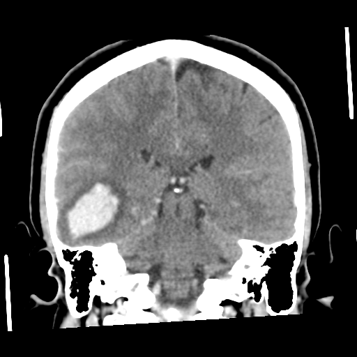 Cerebral hemorrhage secondary to arteriovenous malformation (Radiopaedia 33497-34561 C 41).png