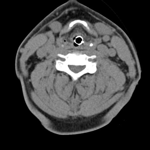 Cerebral hemorrhagic contusions and cervical spine fractures (Radiopaedia 32865-33841 F 30).jpg
