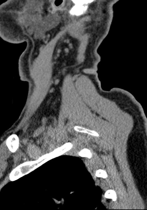 Cerebral hemorrhagic contusions and cervical spine fractures (Radiopaedia 32865-33841 G 15).jpg