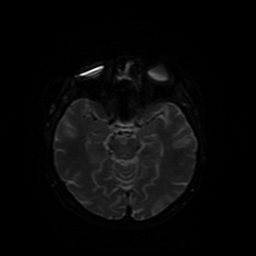 File:Cerebral metastases - melanoma (Radiopaedia 80972-94522 Axial DWI 77).jpg