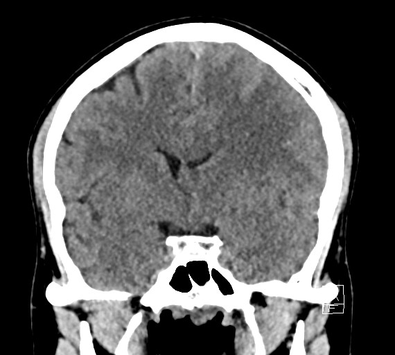 Cerebral metastases - testicular choriocarcinoma (Radiopaedia 84486-99855 Coronal C+ delayed 29).jpg