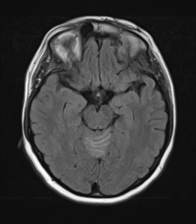 File:Cerebral metastases mimicking abscesses (Radiopaedia 45841-50131 Axial FLAIR 12).png