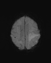 File:Cerebral metastasis (Radiopaedia 46744-51248 Axial SWI 21).png