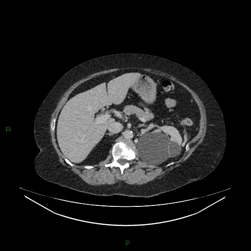 Cerebral metastasis from renal cell carcinoma (Radiopaedia 82306-96378 A 56).jpg