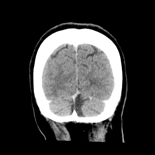 Cerebral metastasis to basal ganglia (Radiopaedia 81568-95412 Coronal C+ delayed 53).png