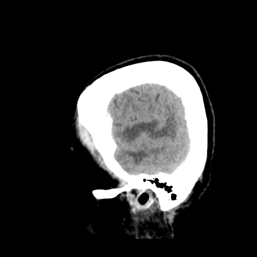 Cerebral metastasis to basal ganglia (Radiopaedia 81568-95412 Sagittal C+ delayed 9).png