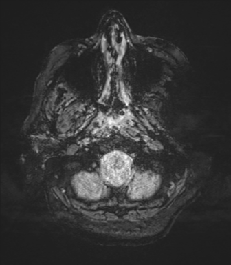 File:Cerebral metastasis to basal ganglia (Radiopaedia 81568-95413 Axial SWI magnitude 5).png