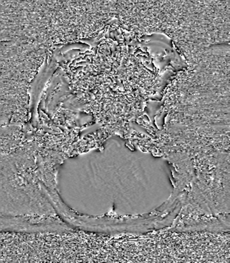 Cerebral metastasis to basal ganglia (Radiopaedia 81568-95413 Axial SWI phase 14).png
