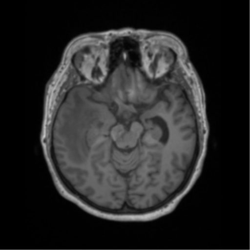 Cerebral metastasis to basal ganglia (Radiopaedia 81568-95413 Axial T1 27).png