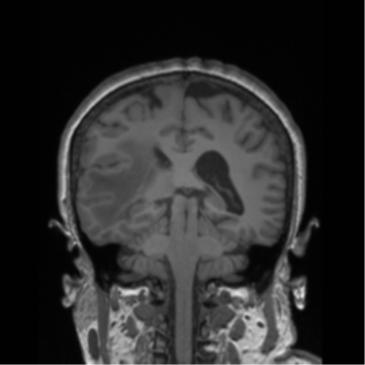 Cerebral metastasis to basal ganglia (Radiopaedia 81568-95413 Coronal T1 16).png