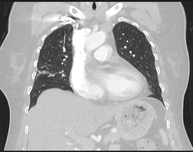 File:Cerebral metastasis to basal ganglia (Radiopaedia 81568-95414 Coronal lung window 36).png