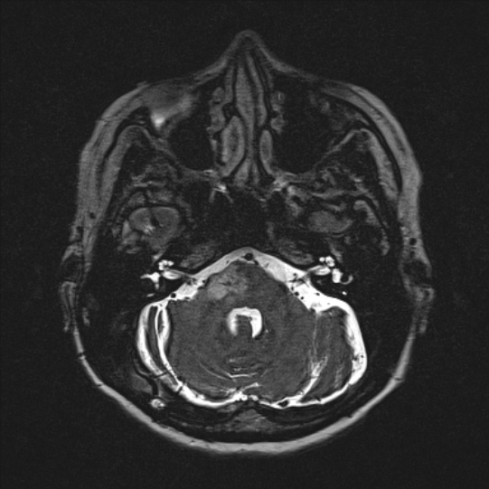 Cerebral ring enhancing lesions - cerebral metastases (Radiopaedia 44922-48817 F 32).jpg