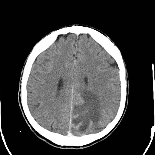 File:Cerebral toxoplasmosis (Radiopaedia 43956-47460 Axial C+ delayed 27).jpg