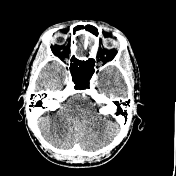 Cerebral toxoplasmosis (Radiopaedia 53993-60131 Axial C+ delayed 18).jpg