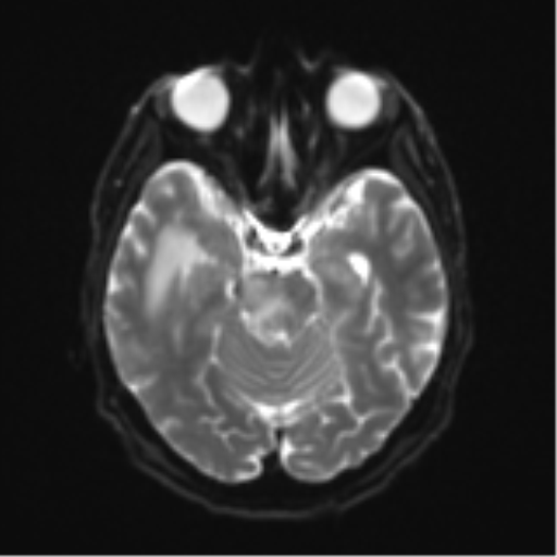 Cerebral toxoplasmosis (Radiopaedia 54575-60804 Axial DWI 13).png