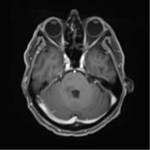 Cerebral toxoplasmosis (Radiopaedia 54575-60804 Axial T1 C+ 18).png