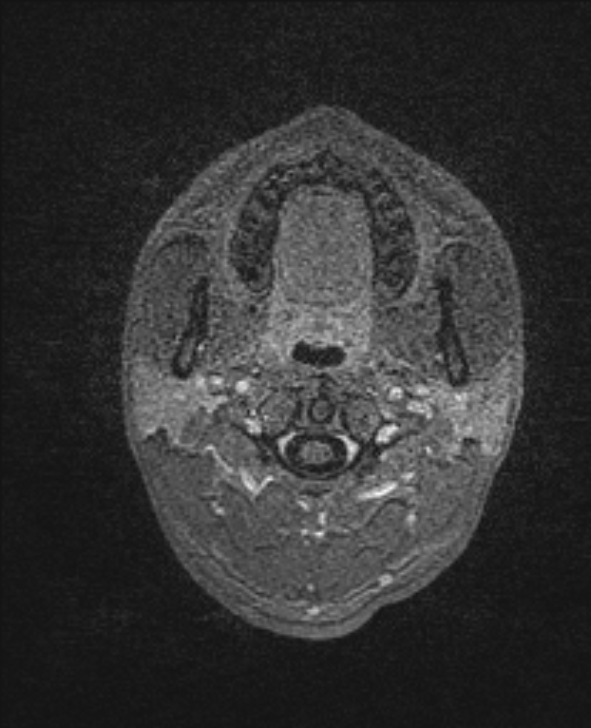 Cerebral toxoplasmosis (Radiopaedia 85779-101597 Axial T1 C+ 1).jpg