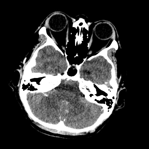 Cerebral tuberculosis with dural sinus invasion (Radiopaedia 60353-68019 Axial C+ delayed 14).jpg