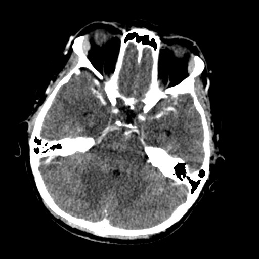 Cerebral tuberculosis with dural sinus invasion (Radiopaedia 60353-68019 Axial C+ delayed 19).jpg