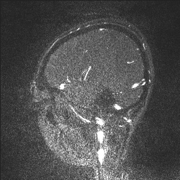 Cerebral tuberculosis with dural sinus invasion (Radiopaedia 60353-68090 Sagittal MRV 123).jpg