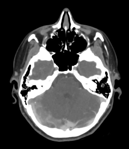 Cerebral venous hemorrhagic infarction (Radiopaedia 38461-40550 Axial MIP VENOGRAM 16).png