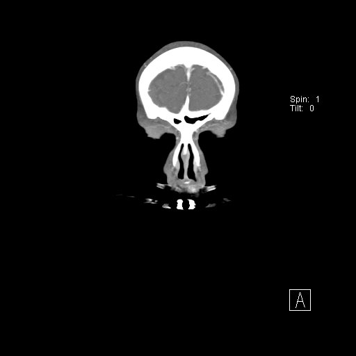 Cerebral venous infarction with hemorrhage (Radiopaedia 65343-74396 B 10).jpg