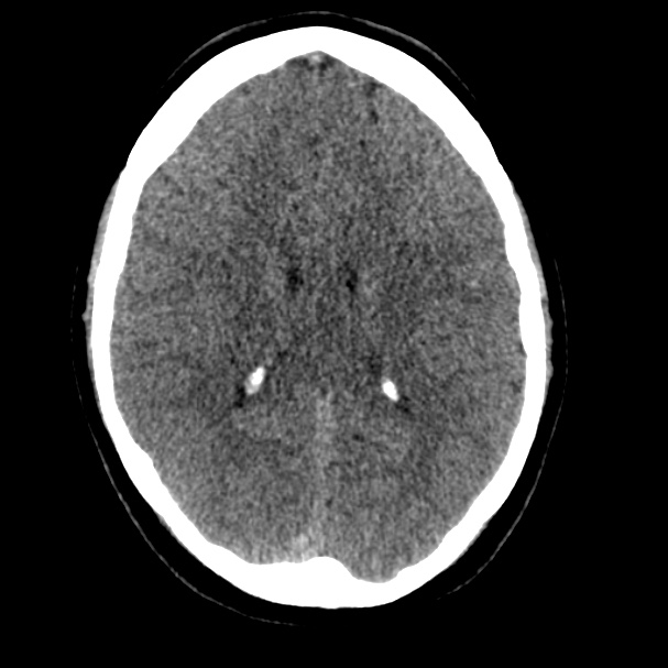 Cerebral venous sinus thrombosis (Radiopaedia 59224-66551 Axial non-contrast 22).jpg