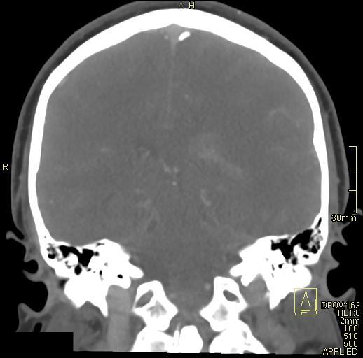 Cerebral venous sinus thrombosis (Radiopaedia 91329-108965 Coronal venogram 54).jpg