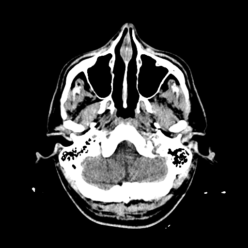 File:Cerebral venous thrombosis (CVT) (Radiopaedia 77524-89685 Axial non-contrast 6).jpg