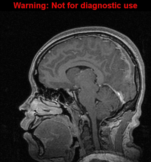 File:Cerebral venous thrombosis (Radiopaedia 37224-39208 Sagittal T1 C+ 83).jpg