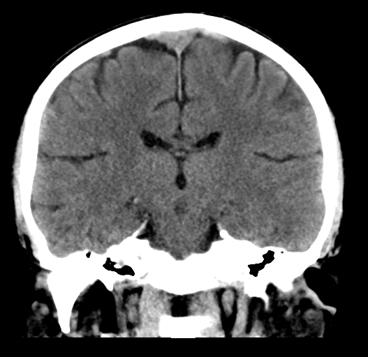 File:Cerebral venous thrombosis (Radiopaedia 38392-40467 Coronal non-contrast 21).png