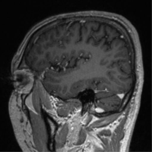 Cerebral venous thrombosis (Radiopaedia 38392-40469 Sagittal T1 C+ 67).png