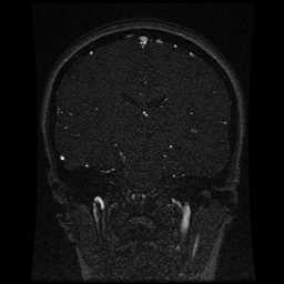 Cerebral venous thrombosis - ulcerative colitis (Radiopaedia 66049-75219 Coronal MRV 56).jpg