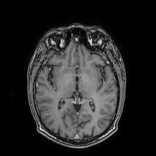 Cerebral venous thrombosis with secondary intracranial hypertension (Radiopaedia 89842-106957 Axial T1 C+ 94).jpg