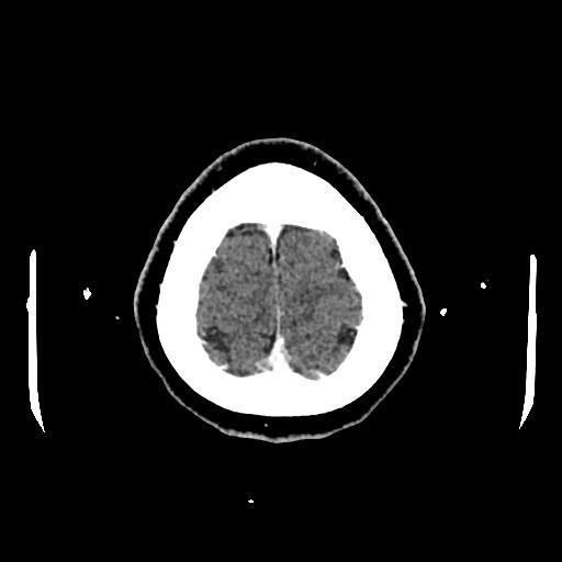 Cerebral venous thrombosis with venous hemorrhagic infarct (Radiopaedia 90354-107660 Axial with contrast 153).jpg