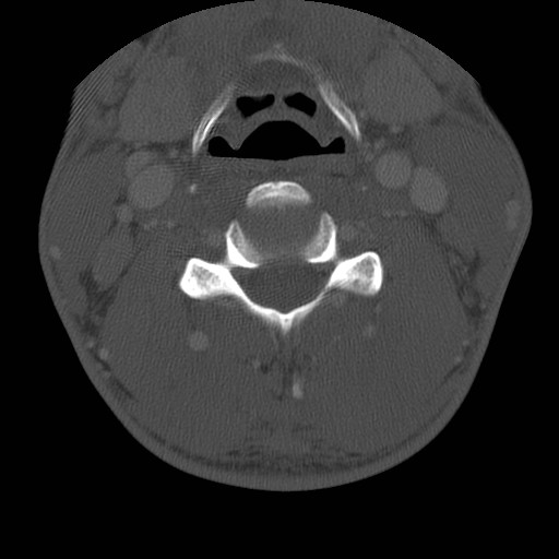 Cervical Pott disease (Radiopaedia 20374-20286 Axial bone window 77).jpg