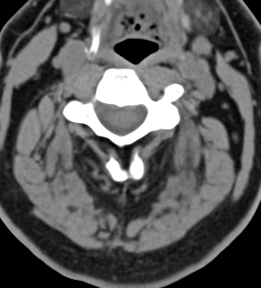 File:Cervical canal stenosis - OPLL and osteophytes (Radiopaedia 47329-51910 Axial non-contrast 25).png
