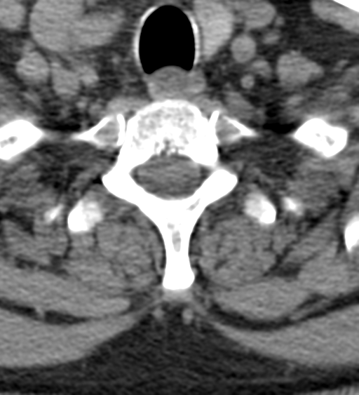 File:Cervical canal stenosis - OPLL and osteophytes (Radiopaedia 47329-51910 Axial non-contrast 54).png