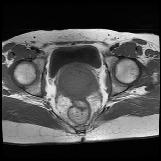File:Cervical cancer (Radiopaedia 62991-71413 Axial T1 13).jpg