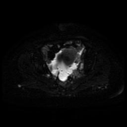 Cervical carcinoma (Radiopaedia 85405-101028 Axial DWI 12).jpg
