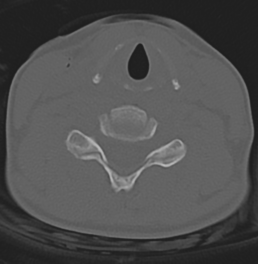 File:Cervical disc replacement (Radiopaedia 37383-39205 Axial bone window 5).png