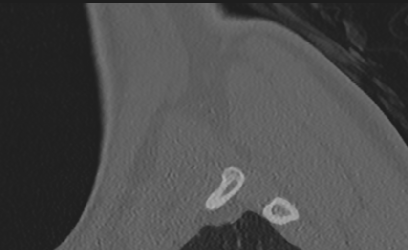 Cervical disc replacement (Radiopaedia 37383-39205 Sagittal bone window 5).png