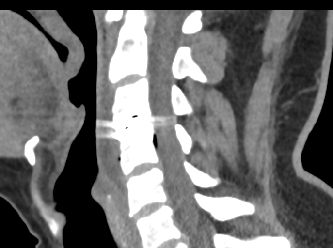 Cervical disc replacement (Radiopaedia 44025-47541 B 48).png
