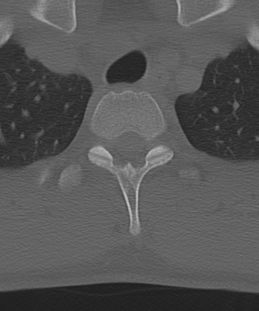 Cervical intercalary bone (Radiopaedia 35211-36748 Axial bone window 68).png
