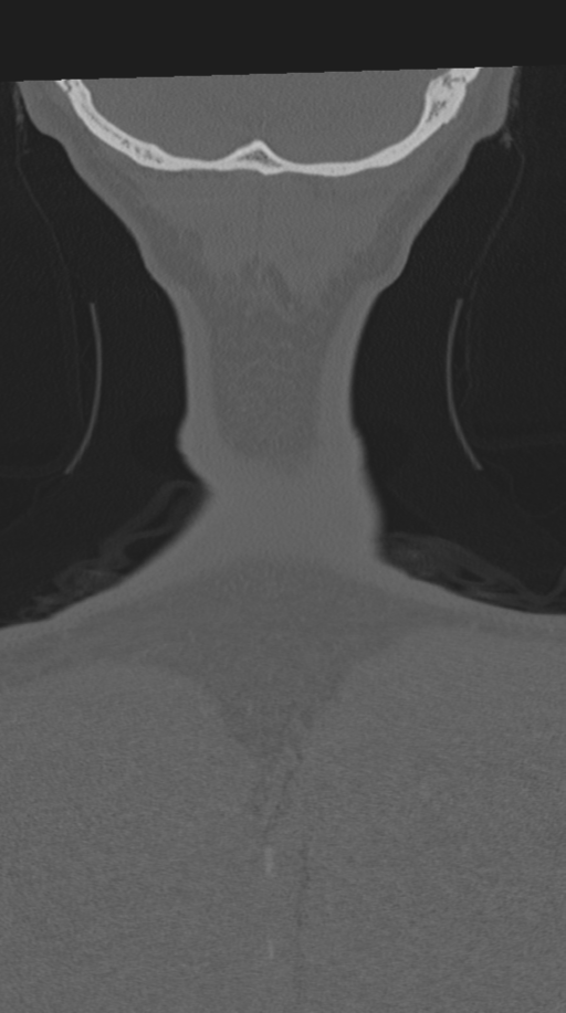 Cervical intercalary bone (Radiopaedia 35211-36748 Coronal bone window 81).png