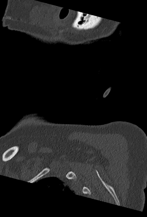 Cervical spine ACDF loosening (Radiopaedia 48998-54070 Sagittal bone window 84).png